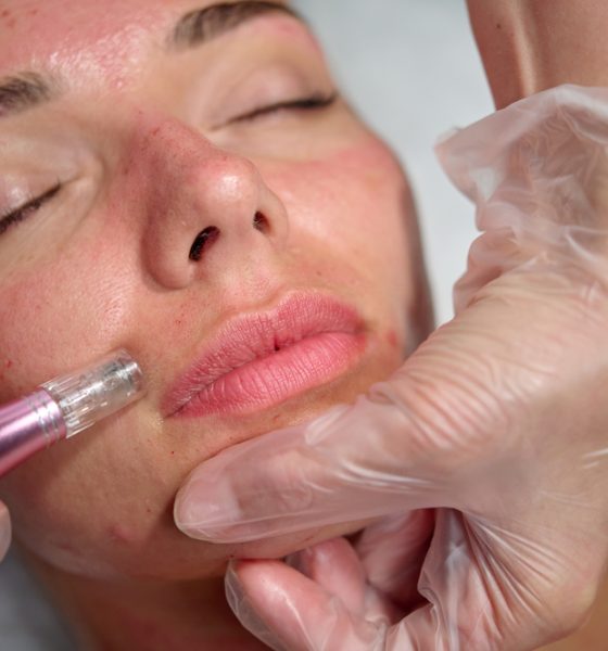 How Much Is Microneedling in Frederick