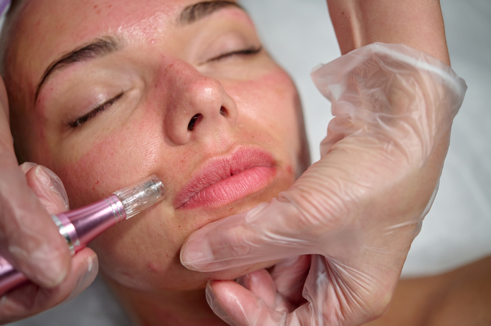 How Much Is Microneedling in Frederick