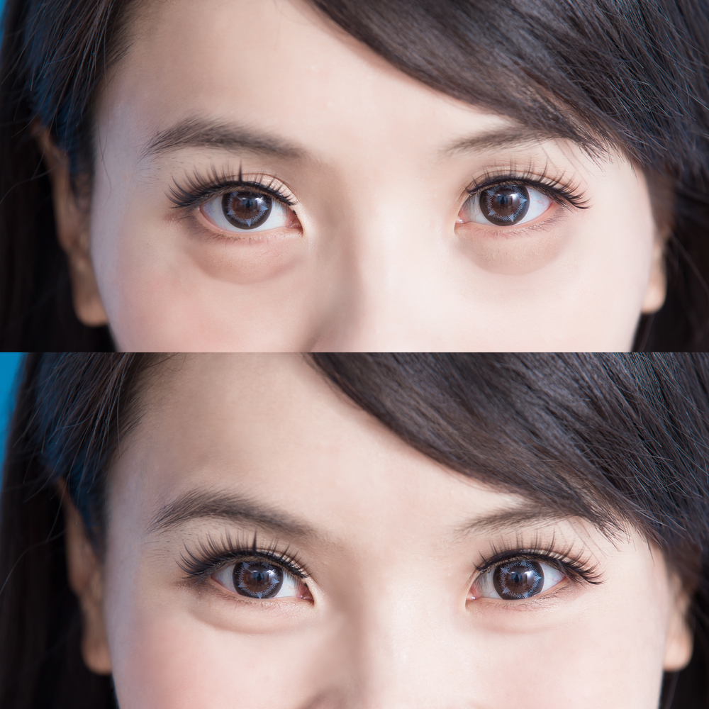 Asian Eyelid Surgery