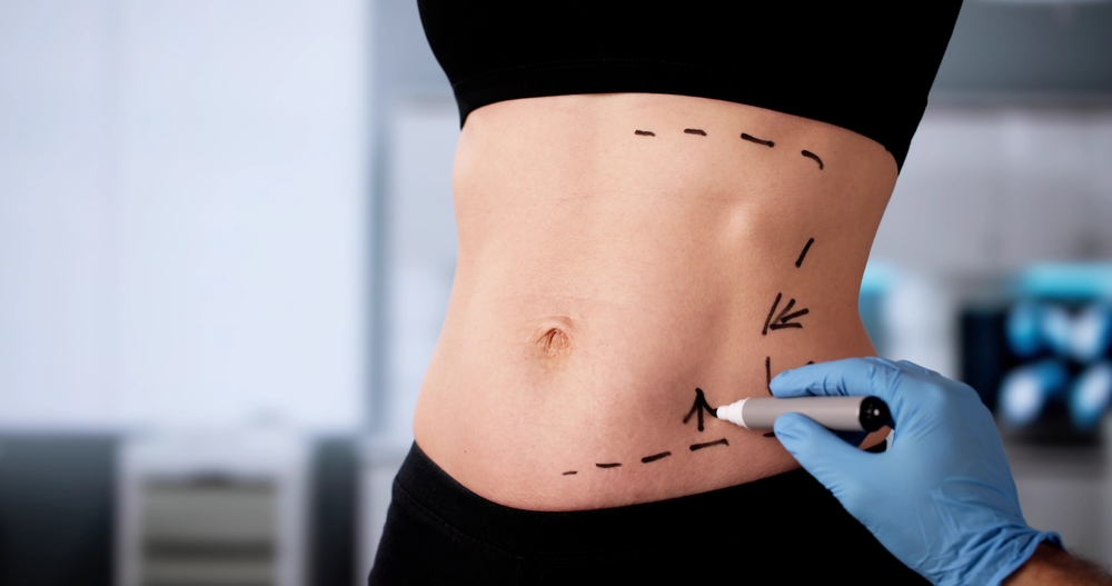 How to Find the Best Liposuction Surgery Prices in Scottsdale, Arizona